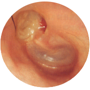 真珠腫性中耳炎の写真
