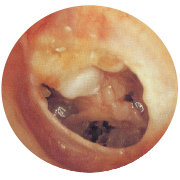 慢性穿孔性中耳炎の写真